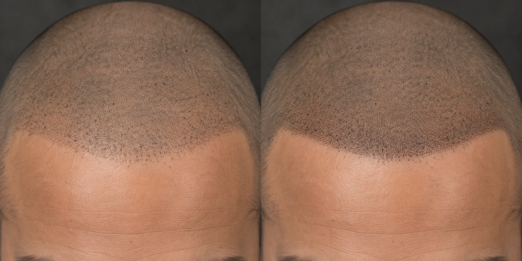 Illustrated scalp with spaced impressions along a gradual front edge