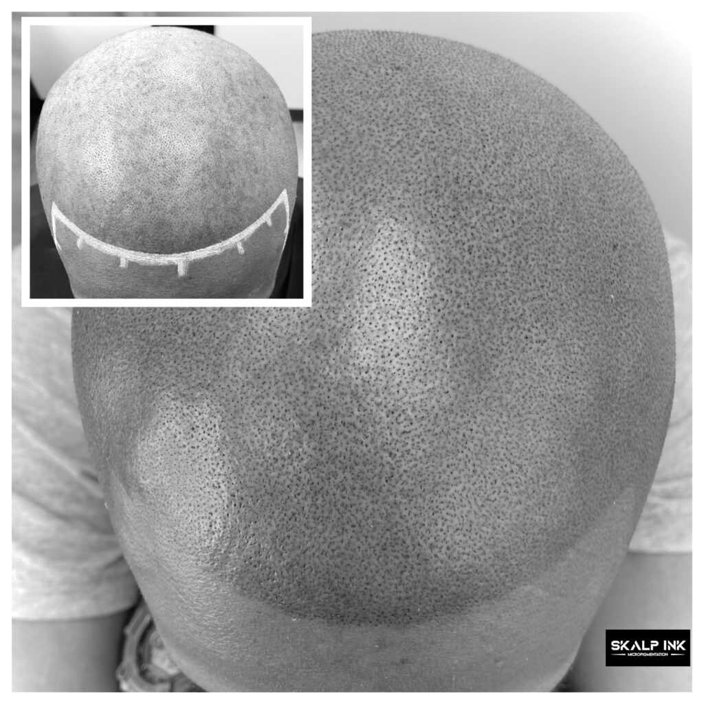 SKALP INK MICROPIGMENTATION