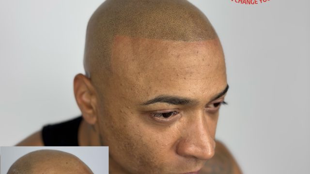 celebrity-hair-loss-solution-smp-delaware