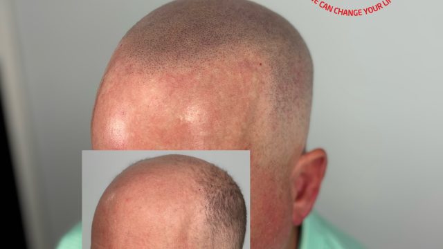delaware-smp-before-after-hairline-restoration