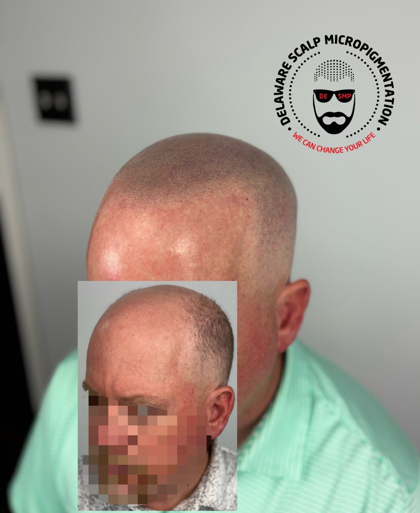 Delaware Scalp Micropigmentation