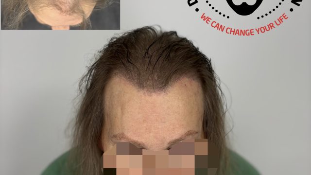 delaware-smp-thinning-hair-solution