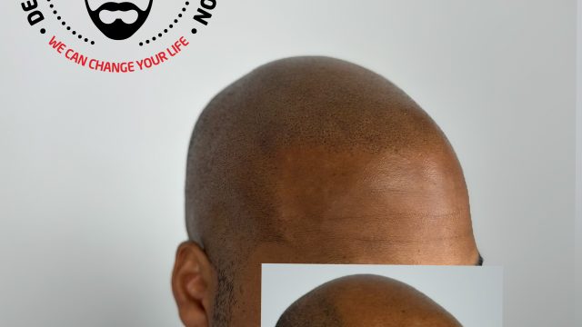 scalp-micropigmentation-on-dark-skin-natural-results