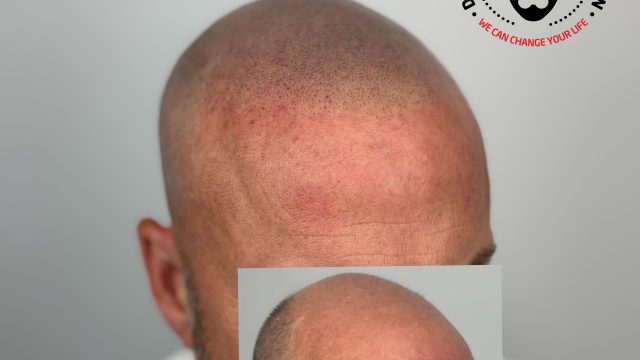 scalp-micropigmentation-results-joey-dots